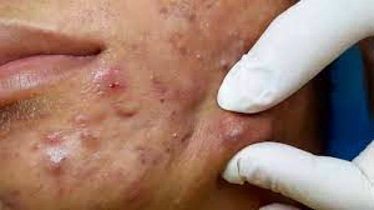 CRAZY Popping huge blackheads and Pimple Popping – BEST Pimple Popping COMPILATION #15