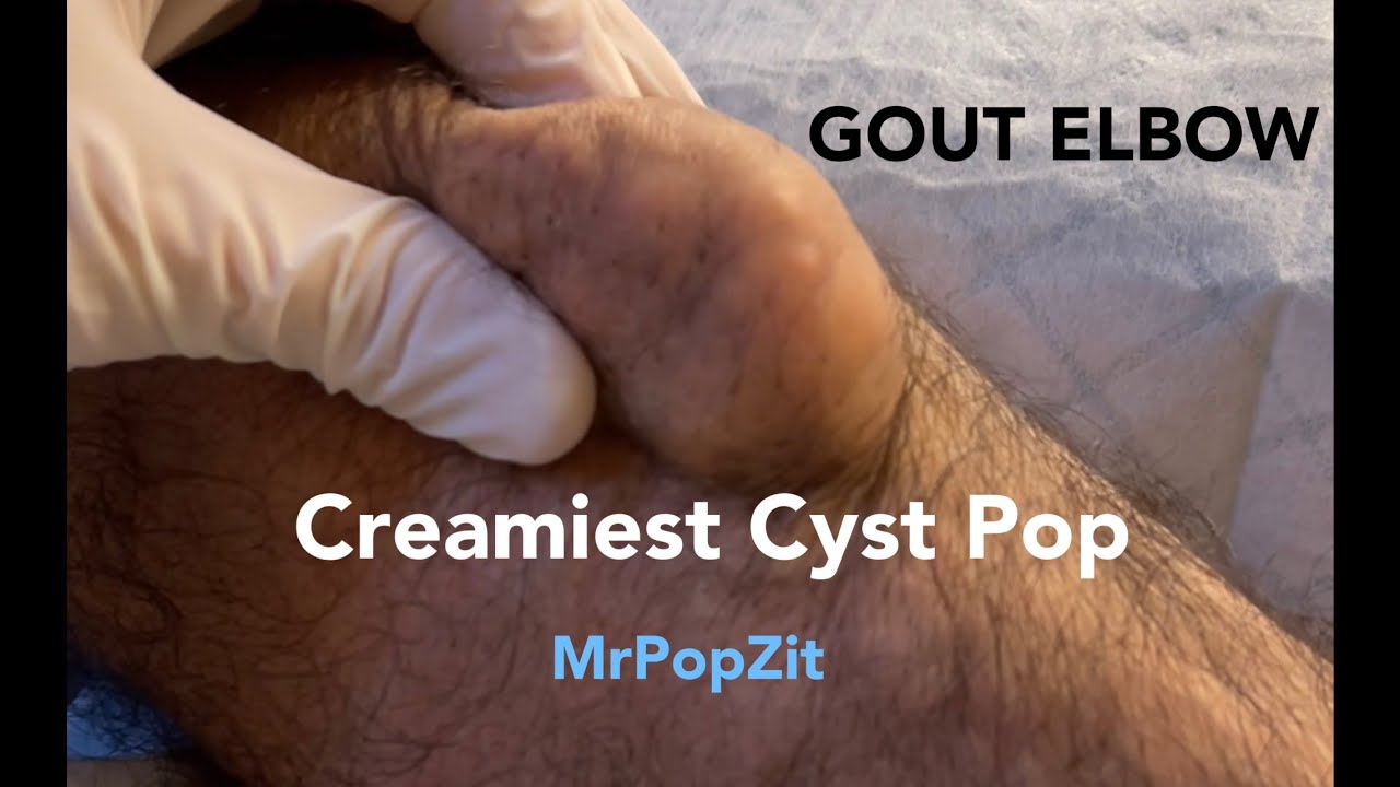 Creamiest cyst pop ever part 1.Gout Elbow.Calcified cyst removed.Tons of cream pushed out. MrPopZit
