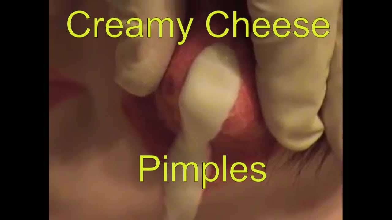 Creamy Cheese Pimple Popping: Nasty Pimples Gone Wild