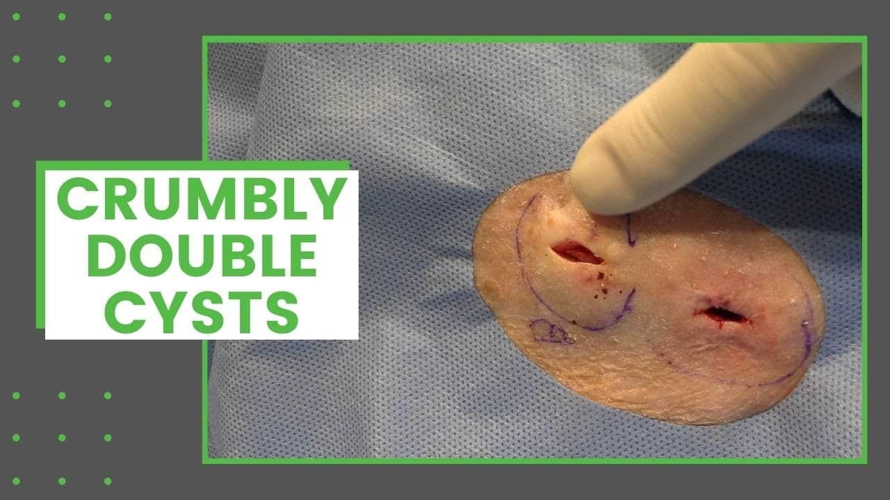 Crumbly Double Cysts | Dr. Derm