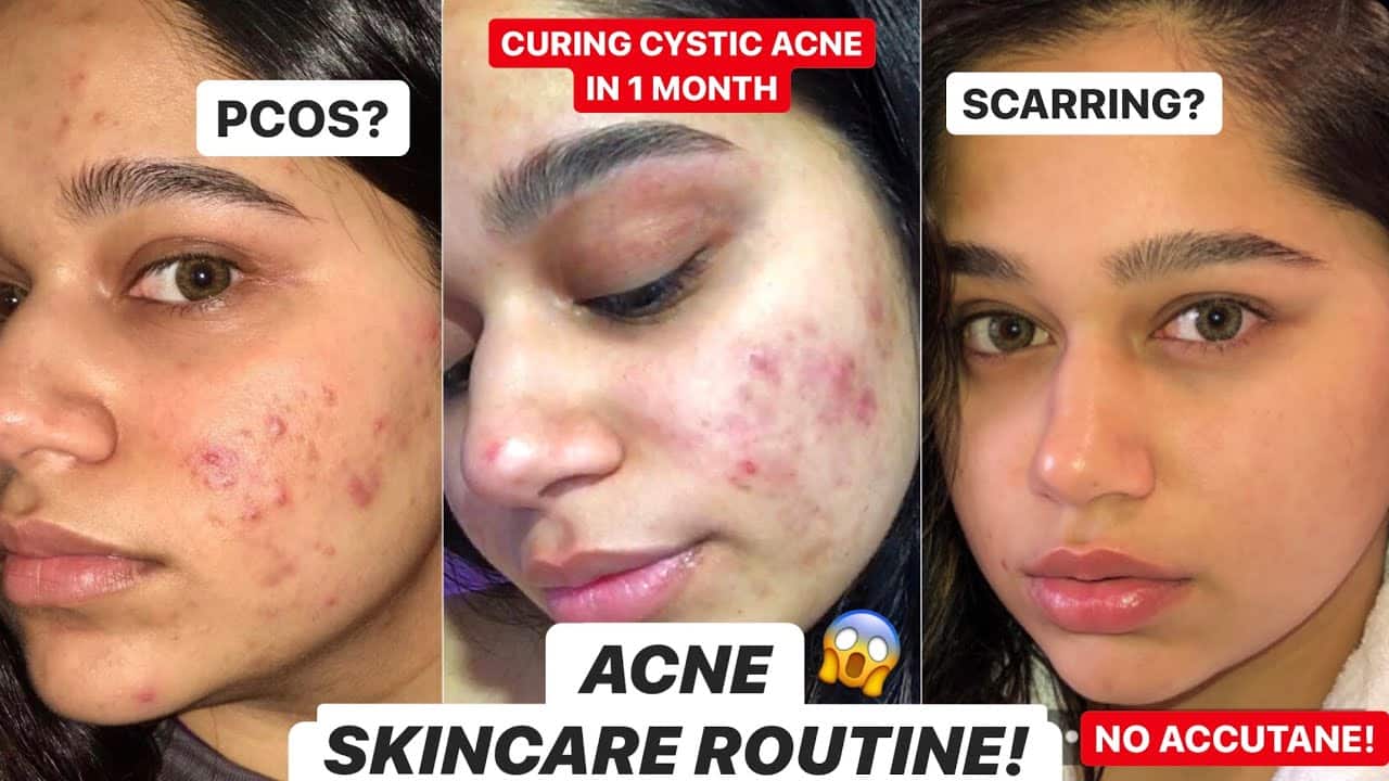 CURING CYSTIC ACNE IN 1 MONTH | SKINCARE ROUTINE #acne #skincare #acnetreatment #skintransformation