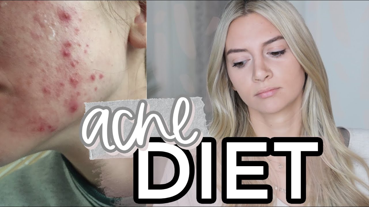 Curing My Hormonal Cystic Acne | My Acne Diet | All Natural, No Accutane | DAIRY + GLUTEN