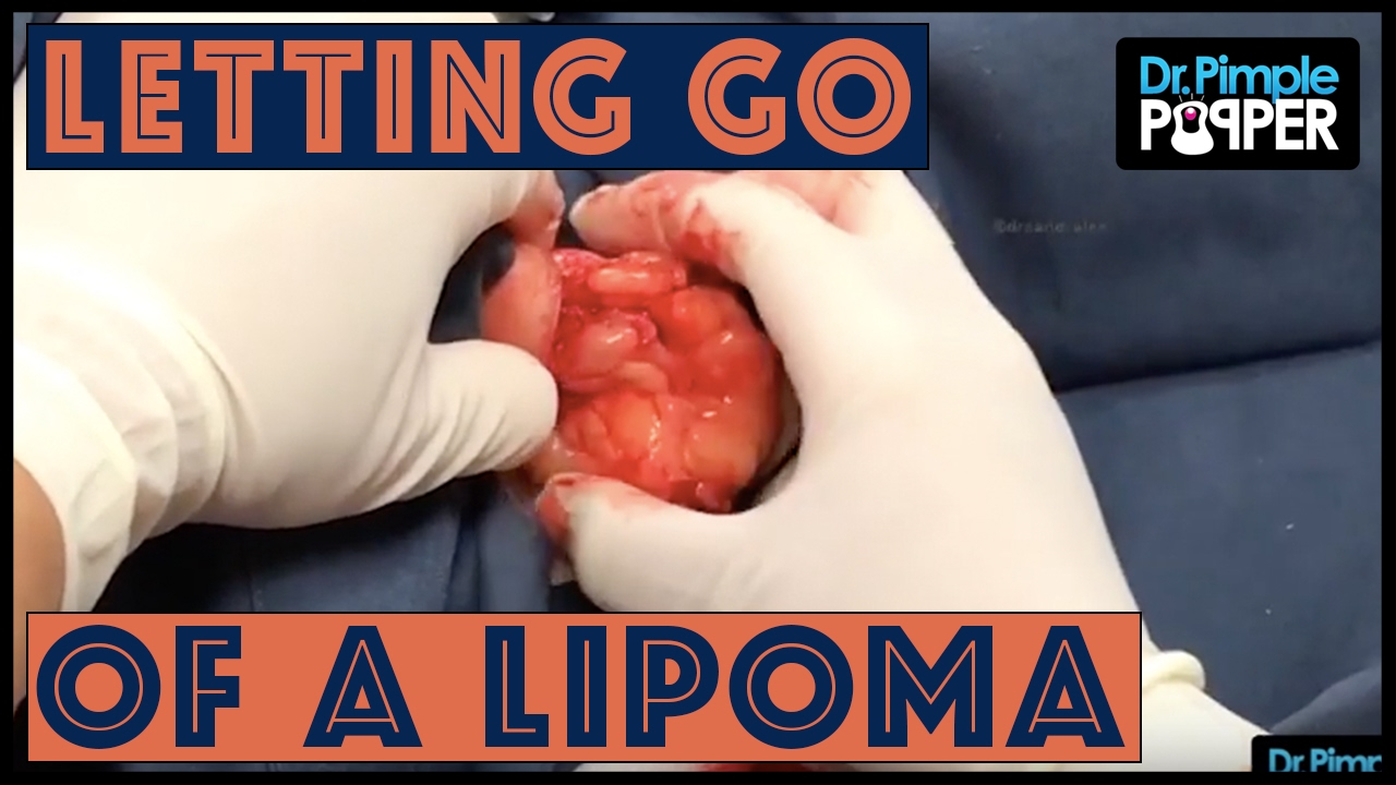 Cuz Breakin’ Up with your Lipoma is Hard to Do