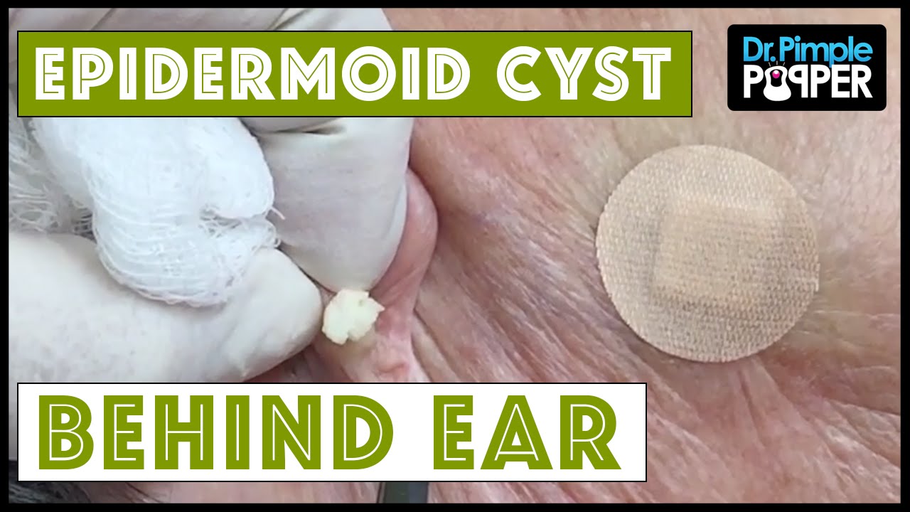 Cyst and Blackheads behind the Ear!
