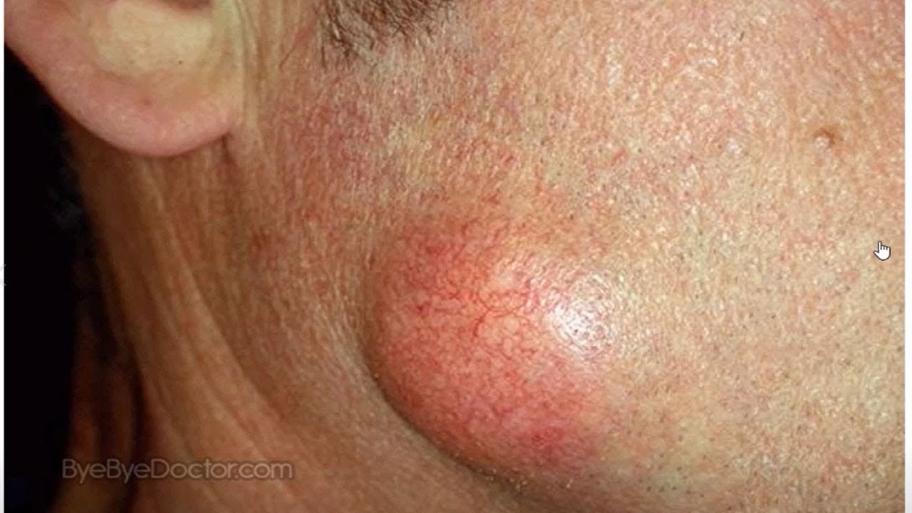 Cyst Bursting Website | Pimples, Infections, Comedones & Biggest Blackheads