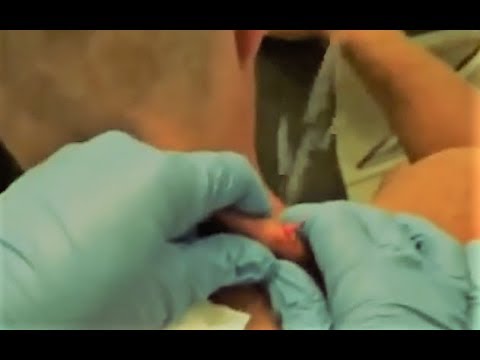 Cyst Compilation Exploding Cyst Educational
