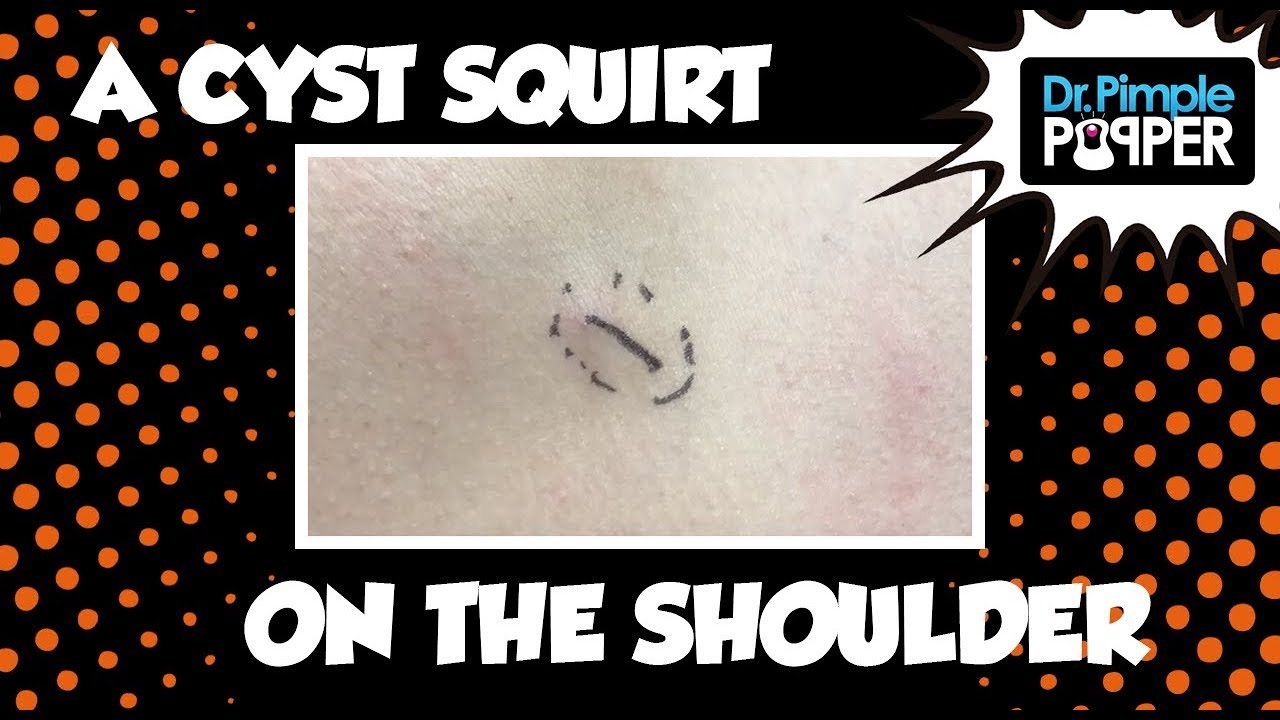 Cyst Disaster BARELY Averted…