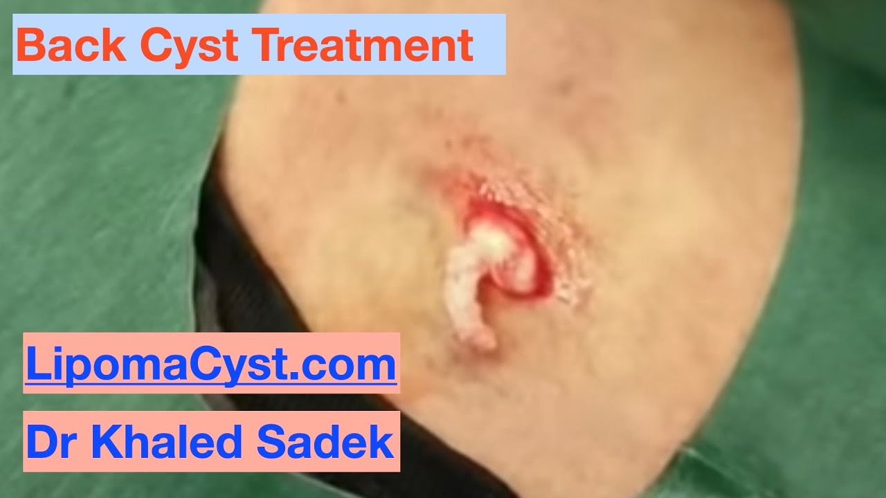 Cyst Eruption. Cyst Removal Clinic London