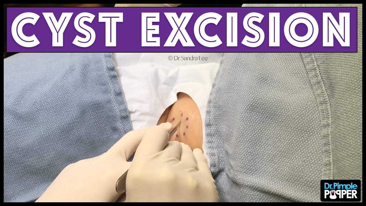 Cyst excised by Dr. Rebish