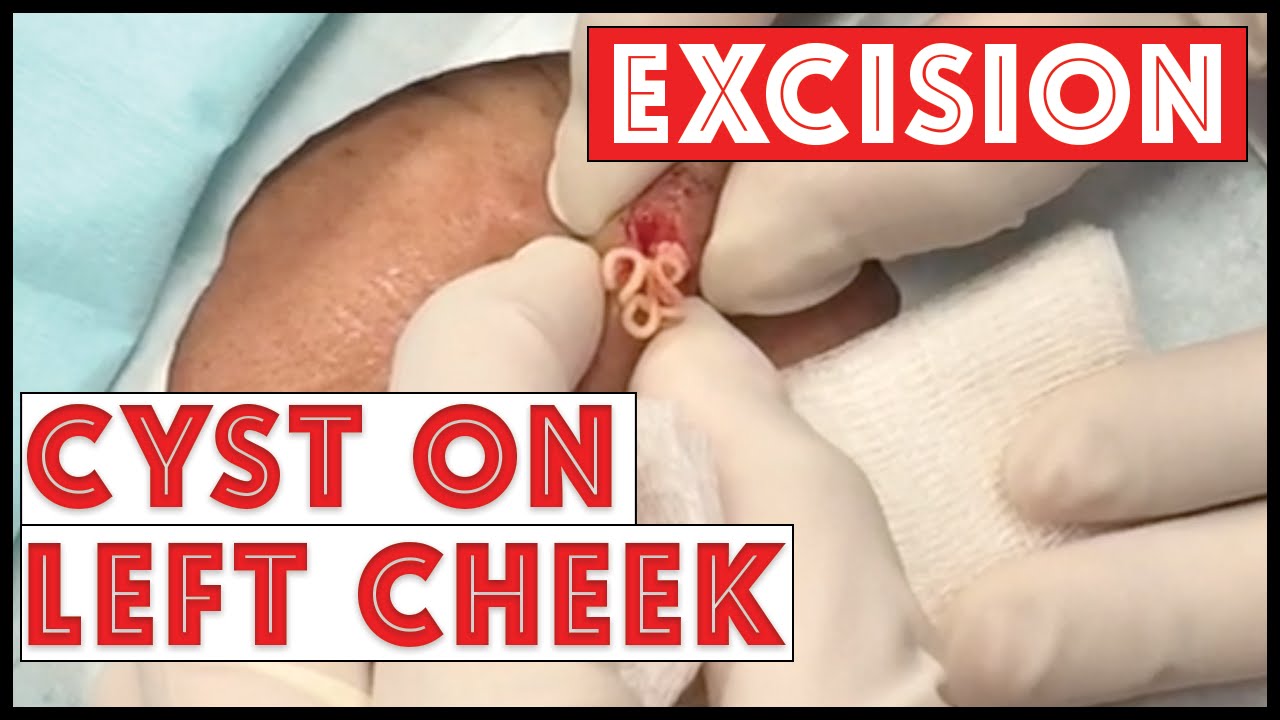 Cyst excision on left cheek