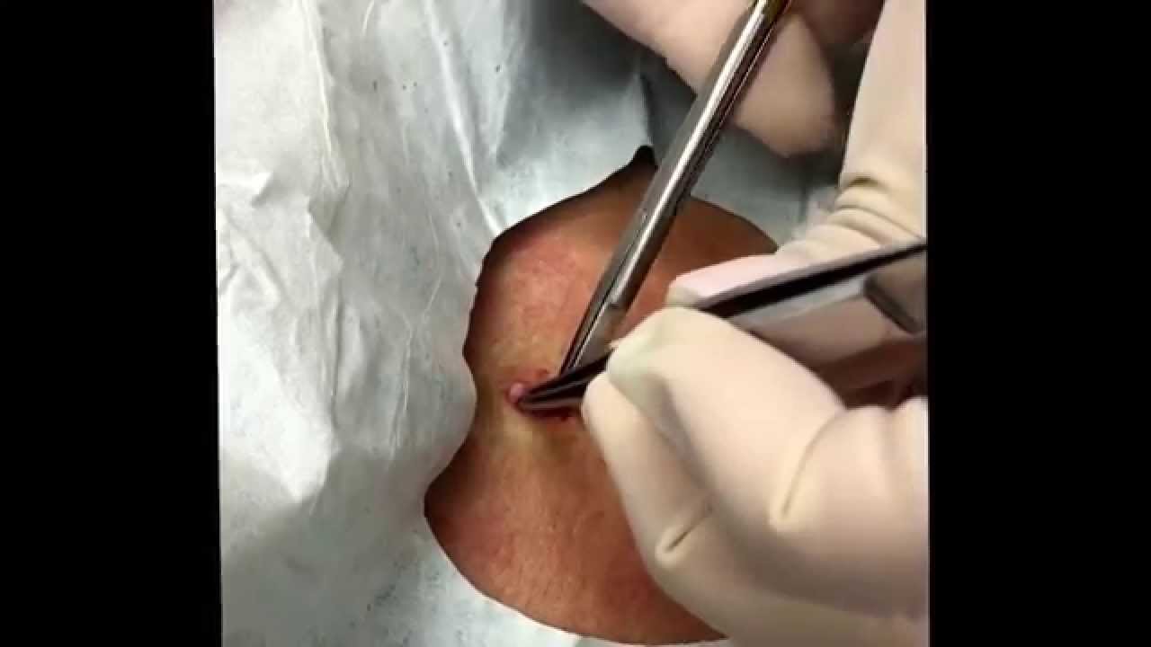Cyst excision on the abdomen. A clean one! For medical education- NSFE.