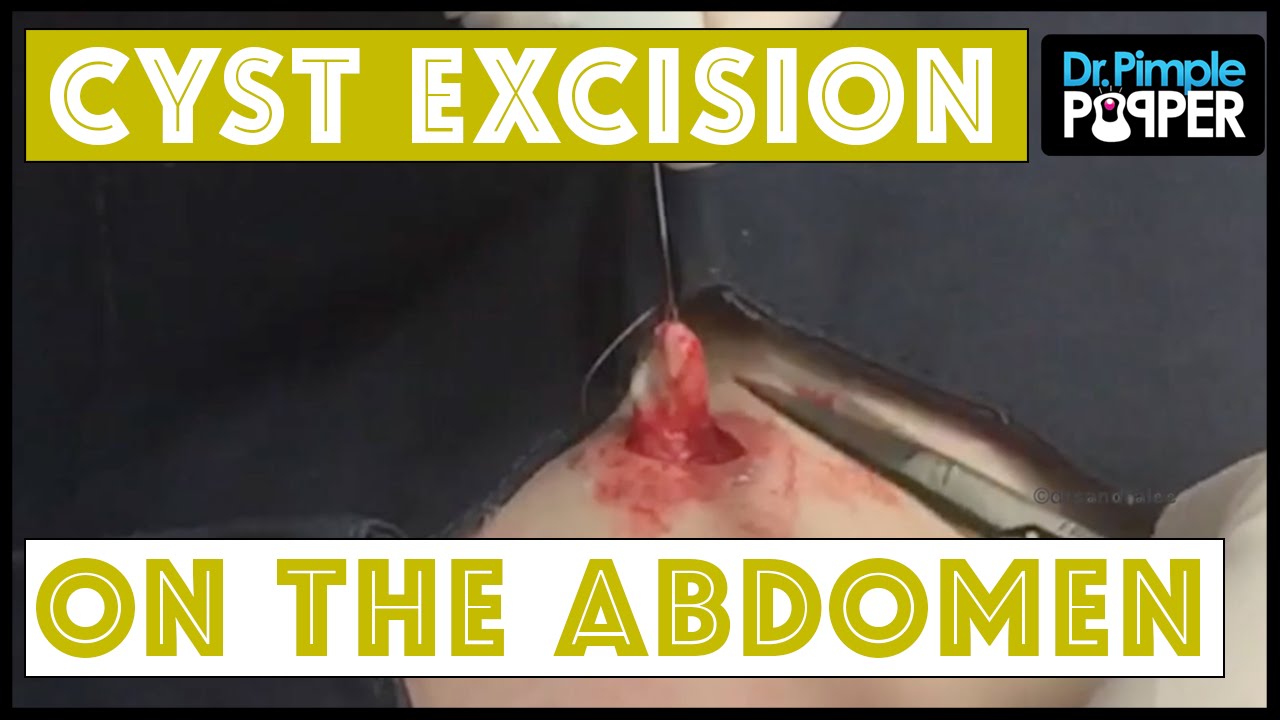 Cyst Excision on the Abdomen