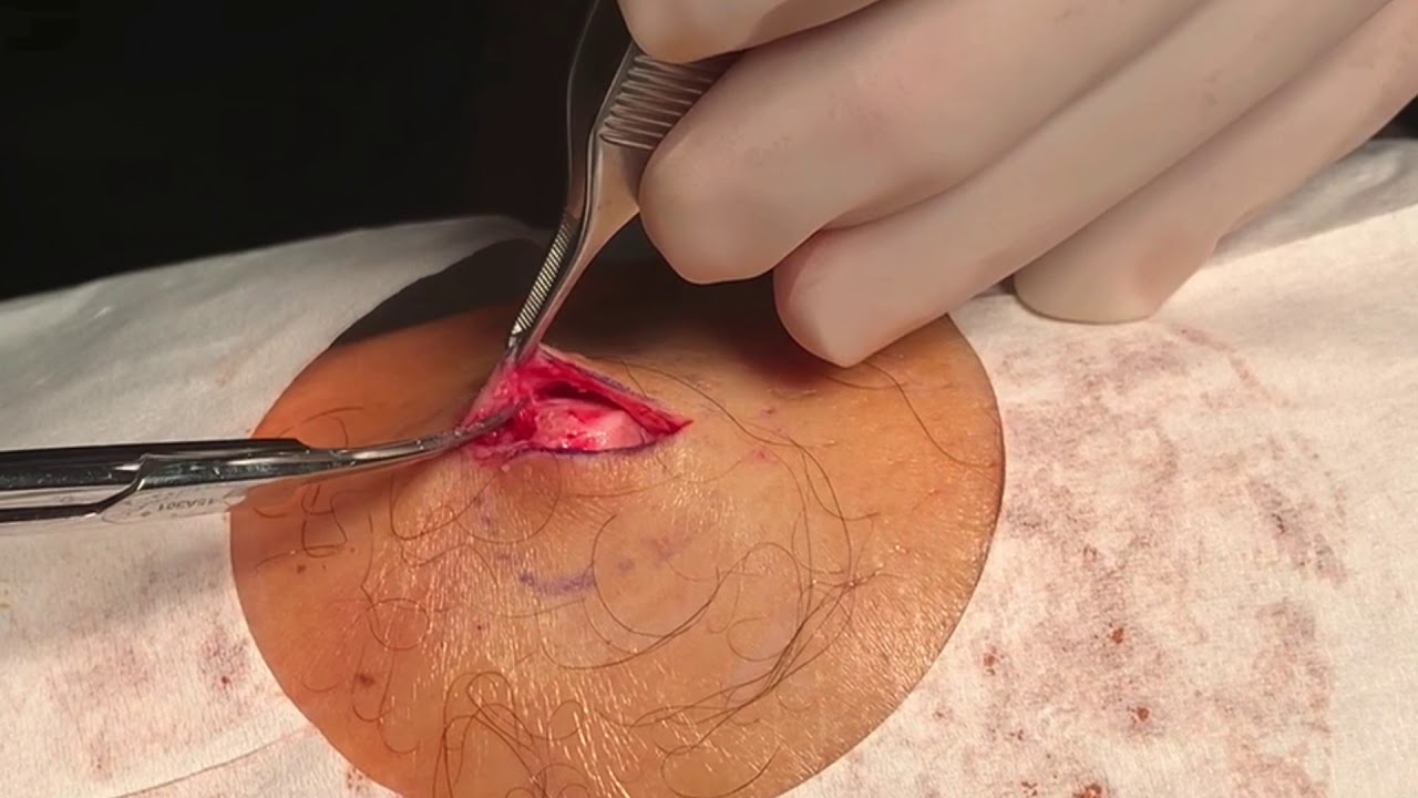 Cyst Excision