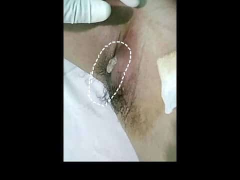 CYST EXTRACTION-ABSCESS-PIMPLE POPPING-BOILS, infeksi bisul