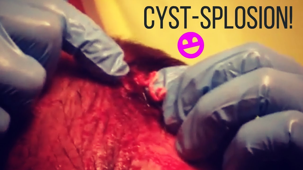 Cyst Extraction | Cyst Removal at Home | Pimple Popping 2018 | Top Shockers