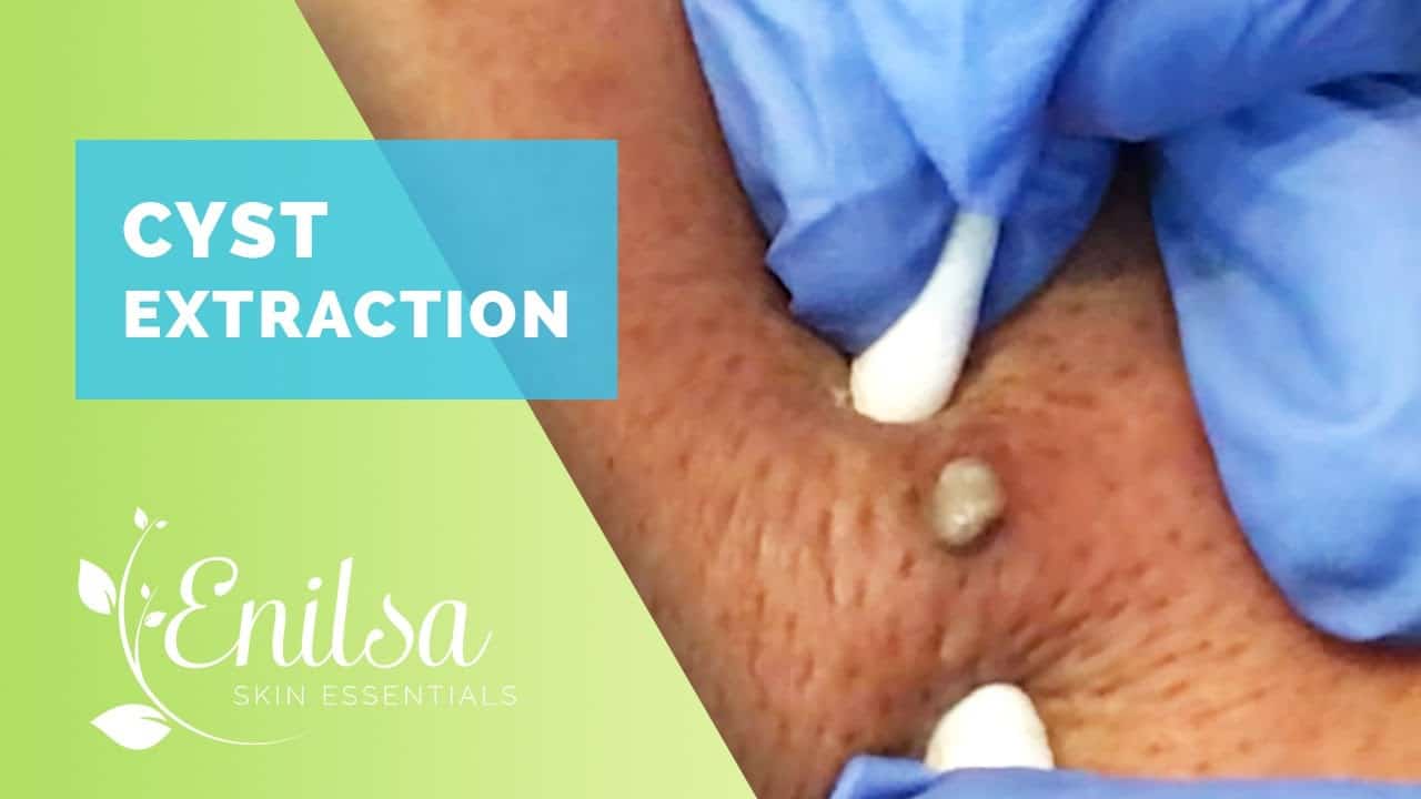 Cyst Extraction Part 1