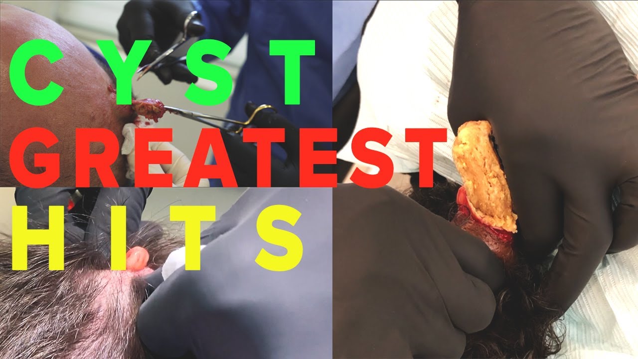 CYST GREATEST HITS!!!!