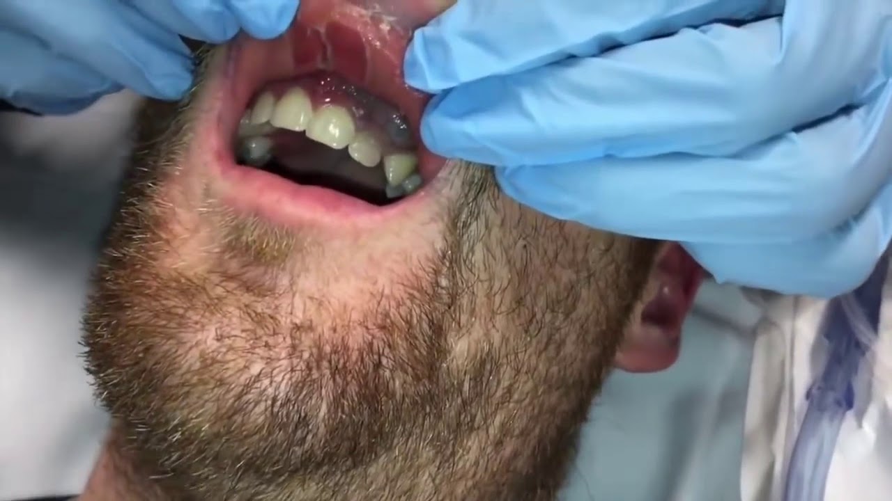 CYST in GUMS Popped – Explosive