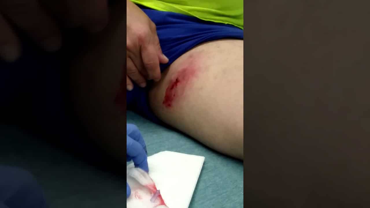 Cyst In Tim's Leg Gets Popped VID 20200804 1154428301