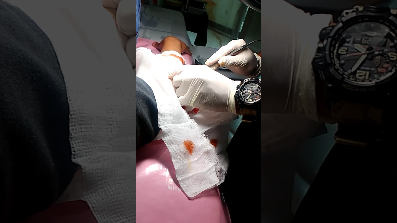 cyst incision and drainage