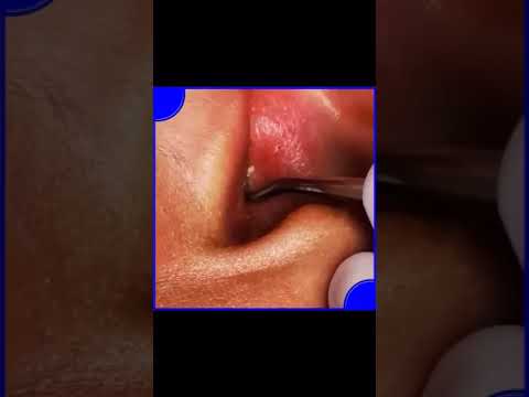 Cyst inside ear / Pus coming out of ear and treatment