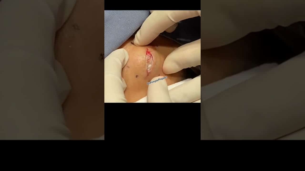 Cyst made of ‘crab’?! 👉🏼🦀👈🏼 |Dr. Pimple Popper #drpimplepopper #cyst #pimplepopping