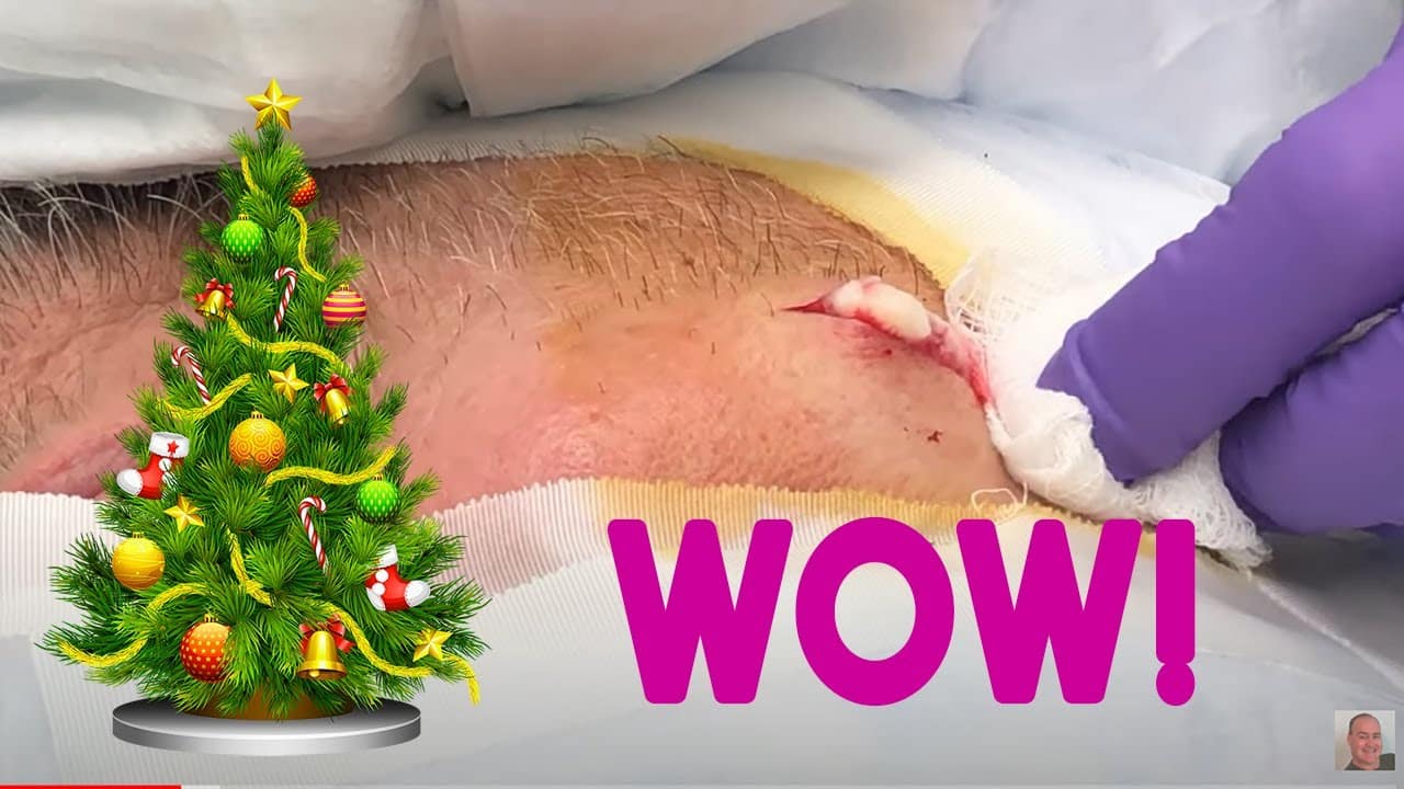 Cyst-mas Time Continues – Another Fantastic Cyst Triple Feature