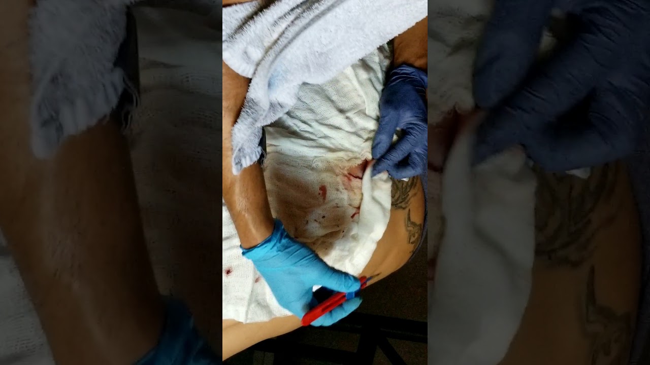 Cyst on back in South Sac part  2 (edited) slightly