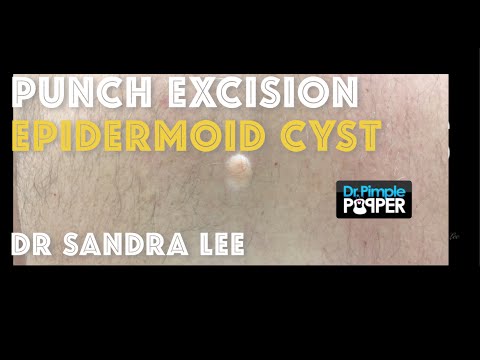 Cyst on the back: Removal via punch excision
