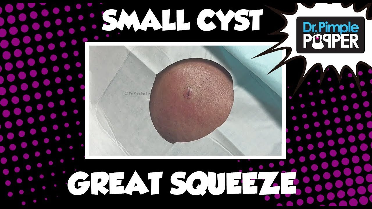 Cyst on the Right Cheek