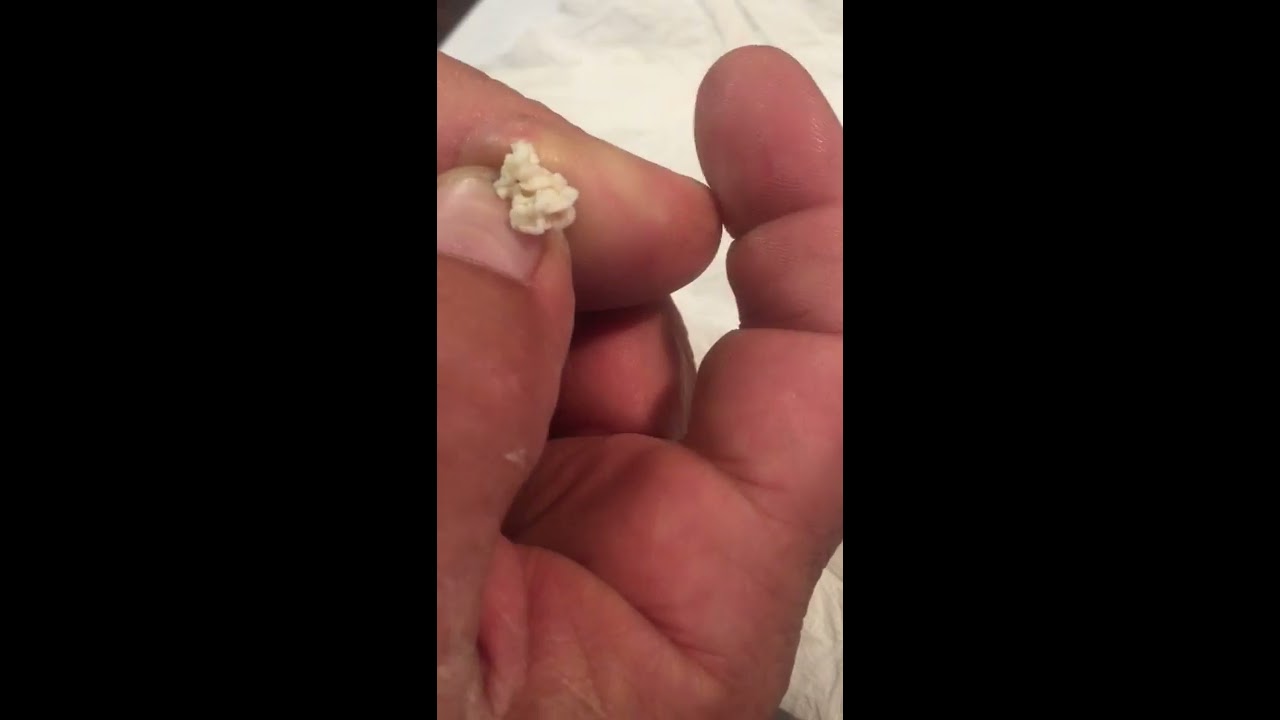 Cyst on thumb popped and drained.