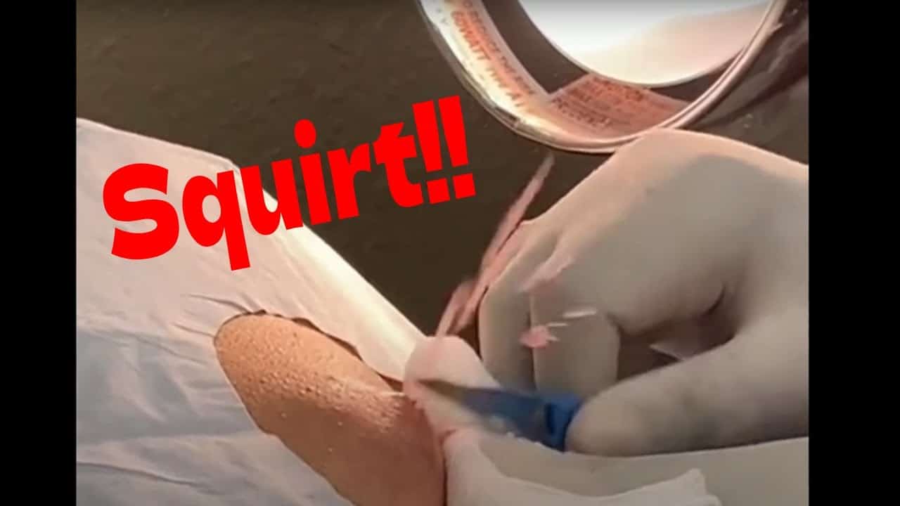 Cyst & Pimple Pops that Squirt!! : explosion