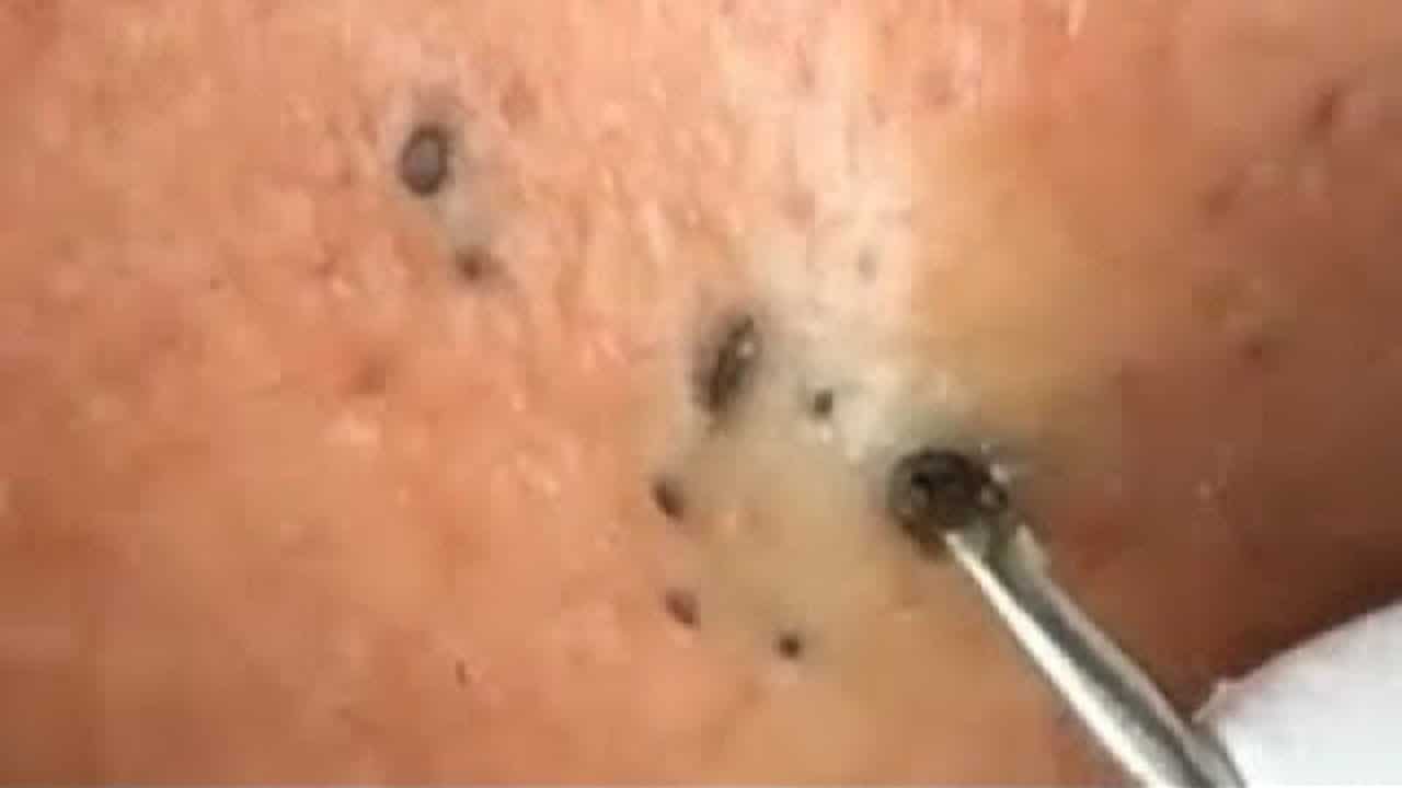 CYST POP AND HUGE BLACKHEAD Removal Videos 2020