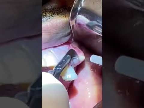 Cyst pop- Dental cyst