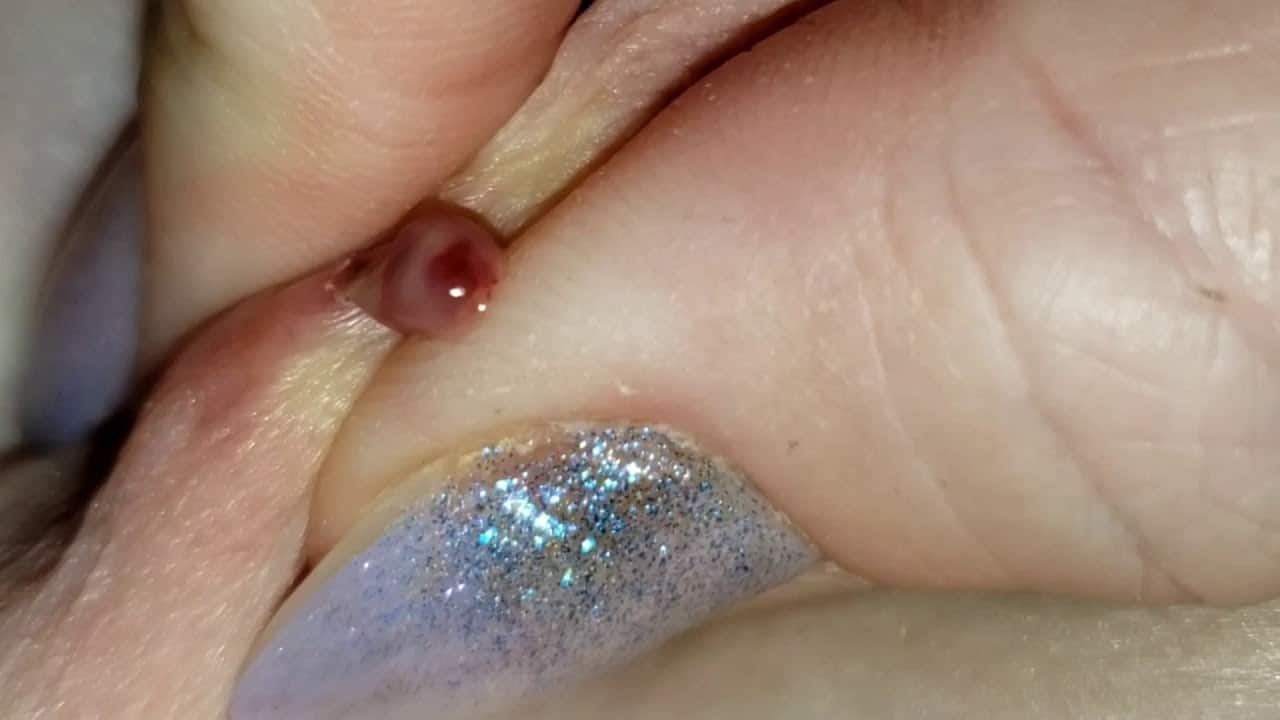 Cyst Pop with blood.