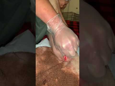 Cyst popped buy doctor booker