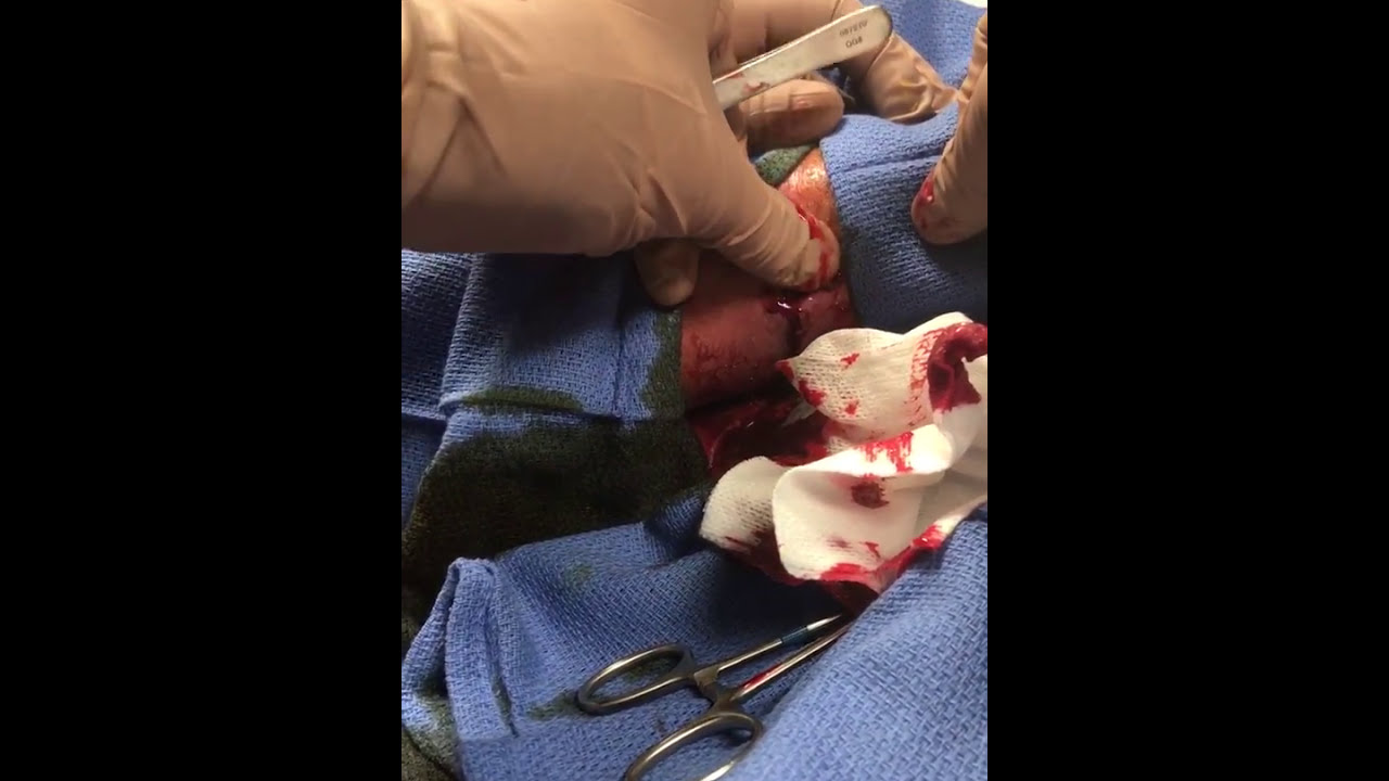 Cyst popped nice and gory