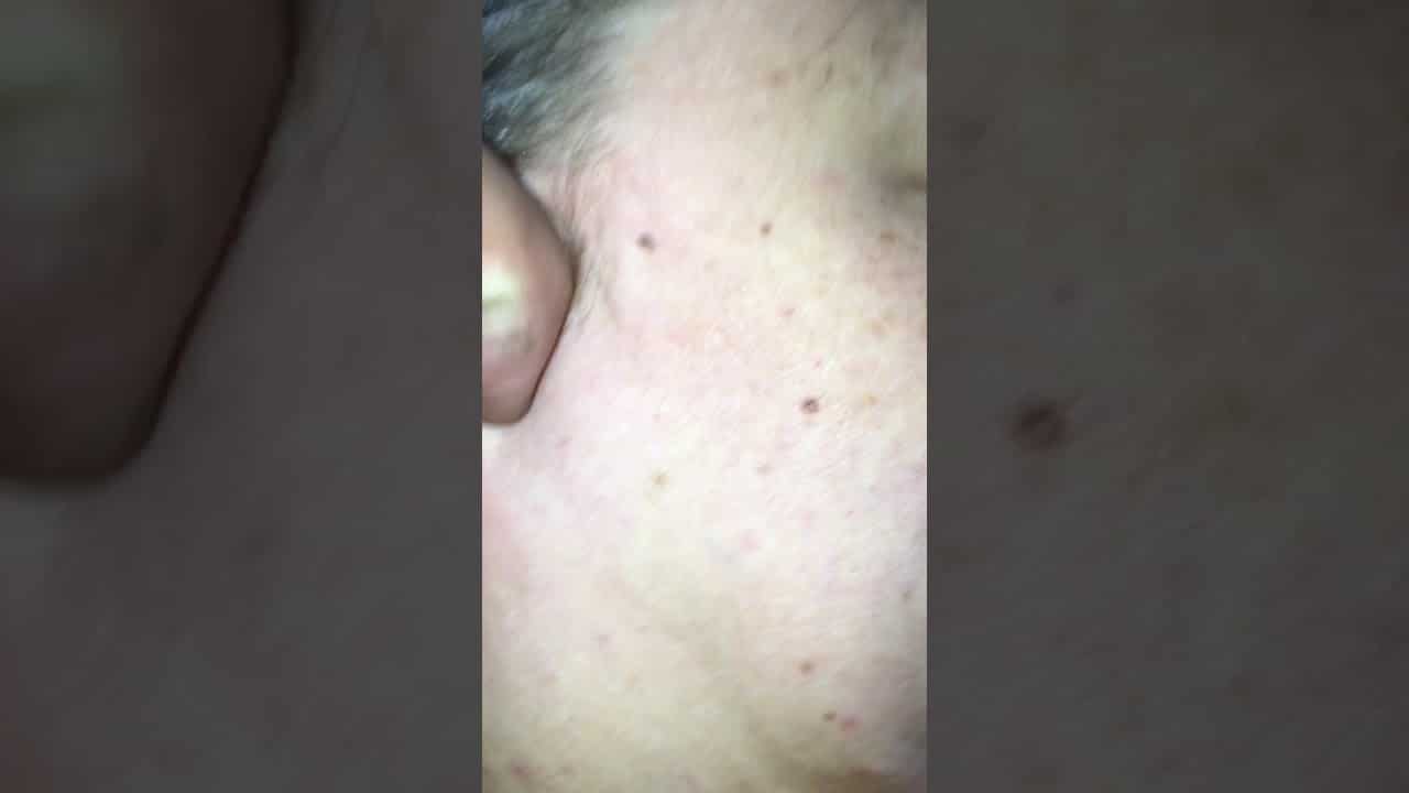 Cyst popped