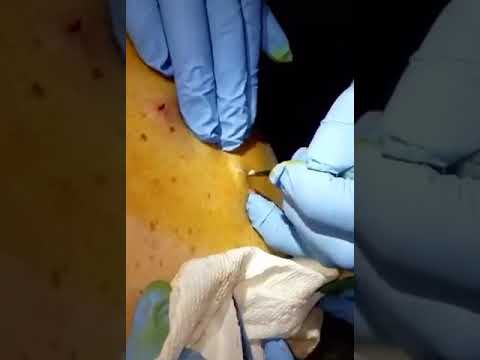 Cyst popping