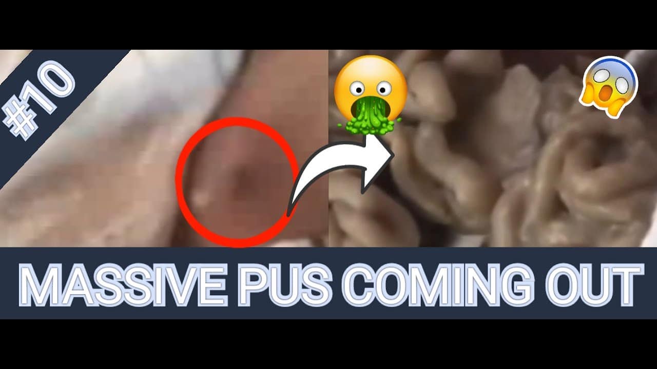 cyst popping 2021 satisfying