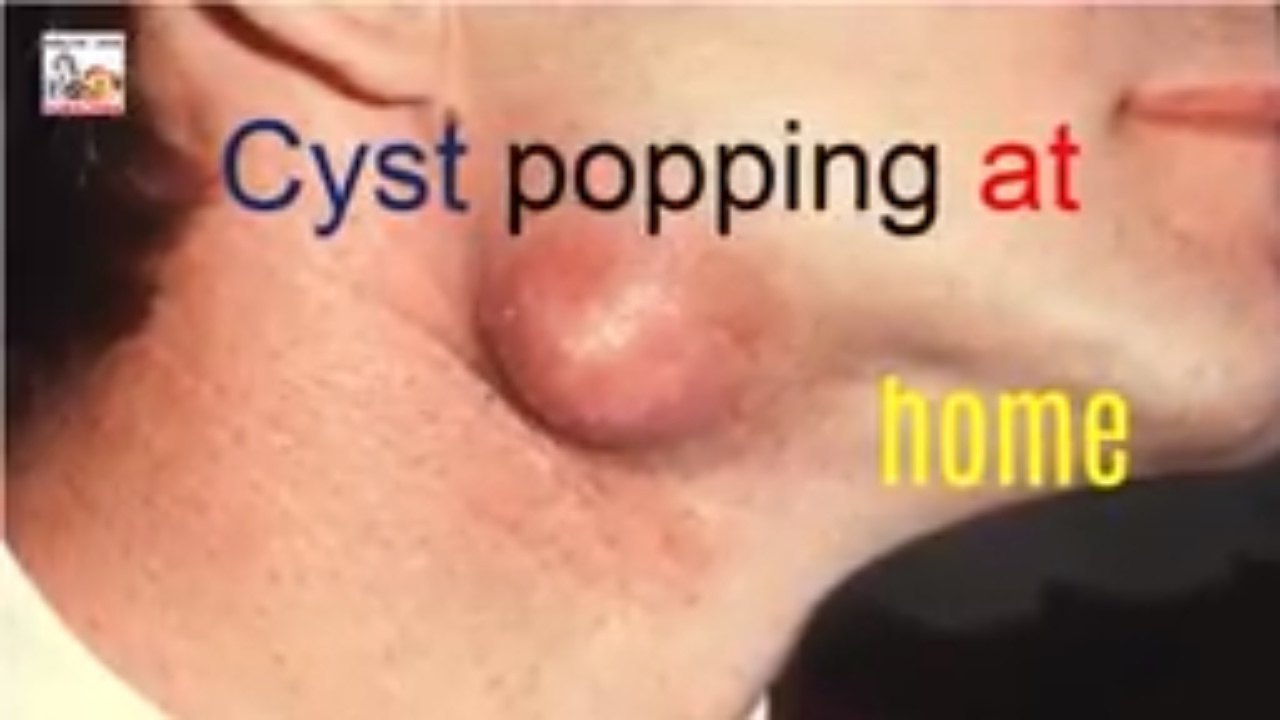 Cyst popping at home – amazing deep cyst pimple popping at home!