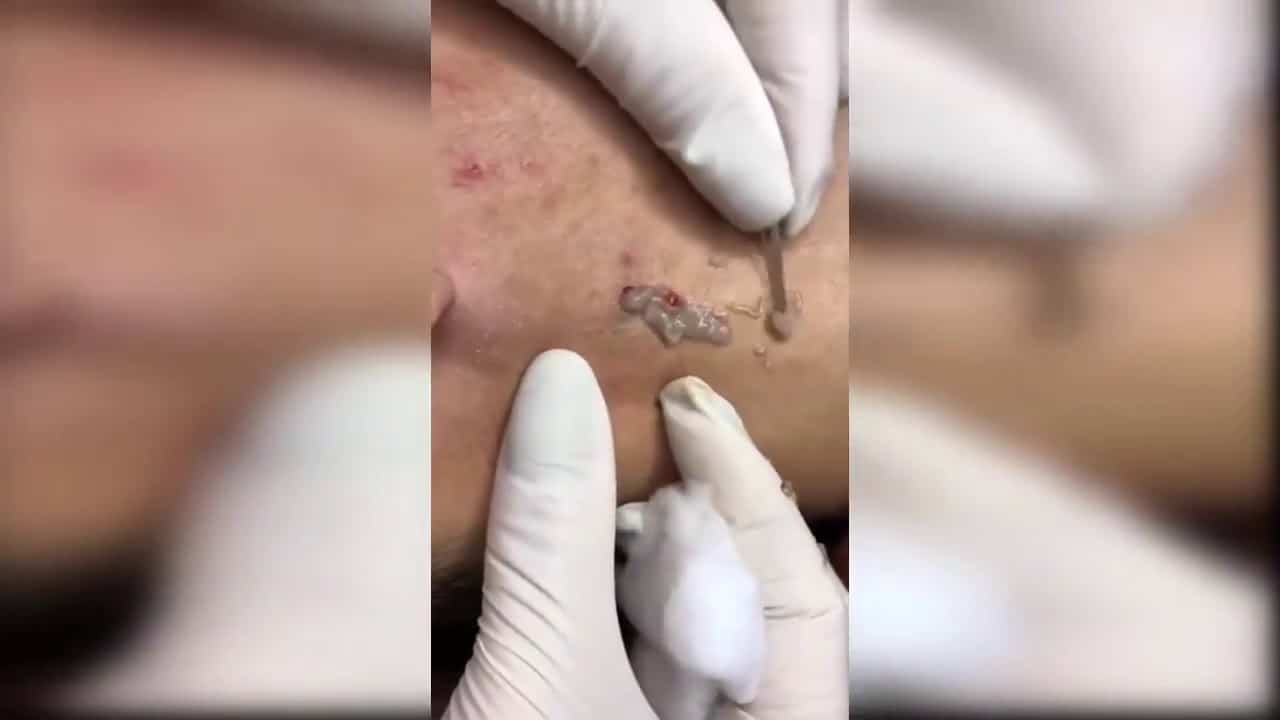 Cyst popping from neck/removal/extraction