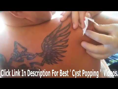 Cyst popping from the back 2018   YouTube