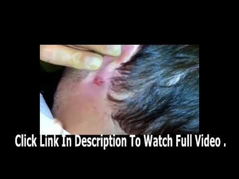 Cyst popping on ear & removal  Old Huge Zit video    YouTube