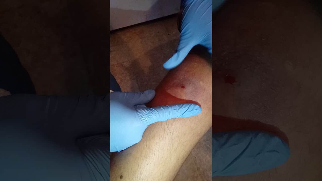Cyst popping part 1