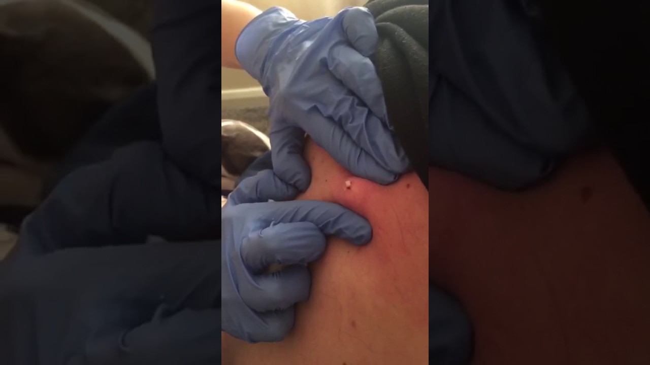 ** CYST POPPING PART TWO **