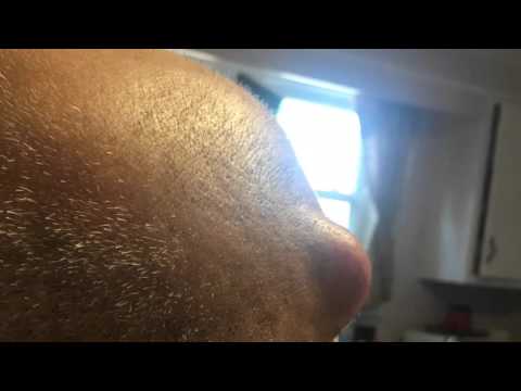 Cyst popping removal