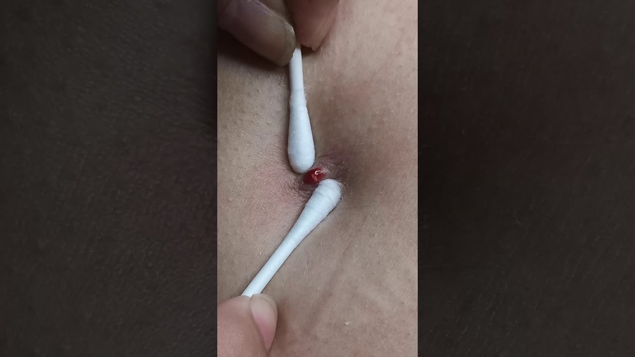 Cyst popping satisfying