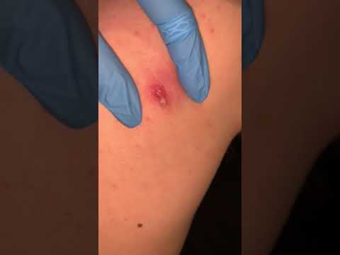 Cyst Popping (WARNING: EXTREMELY GRAPHIC)