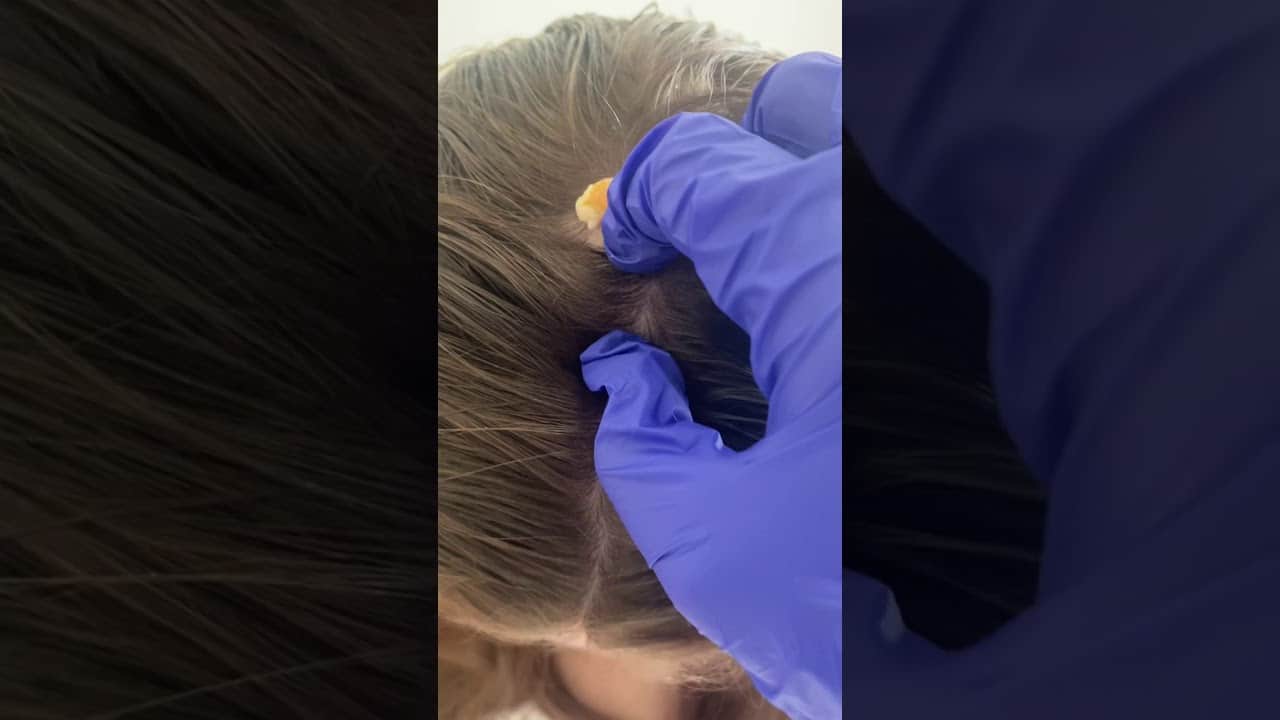 CYST POPPING